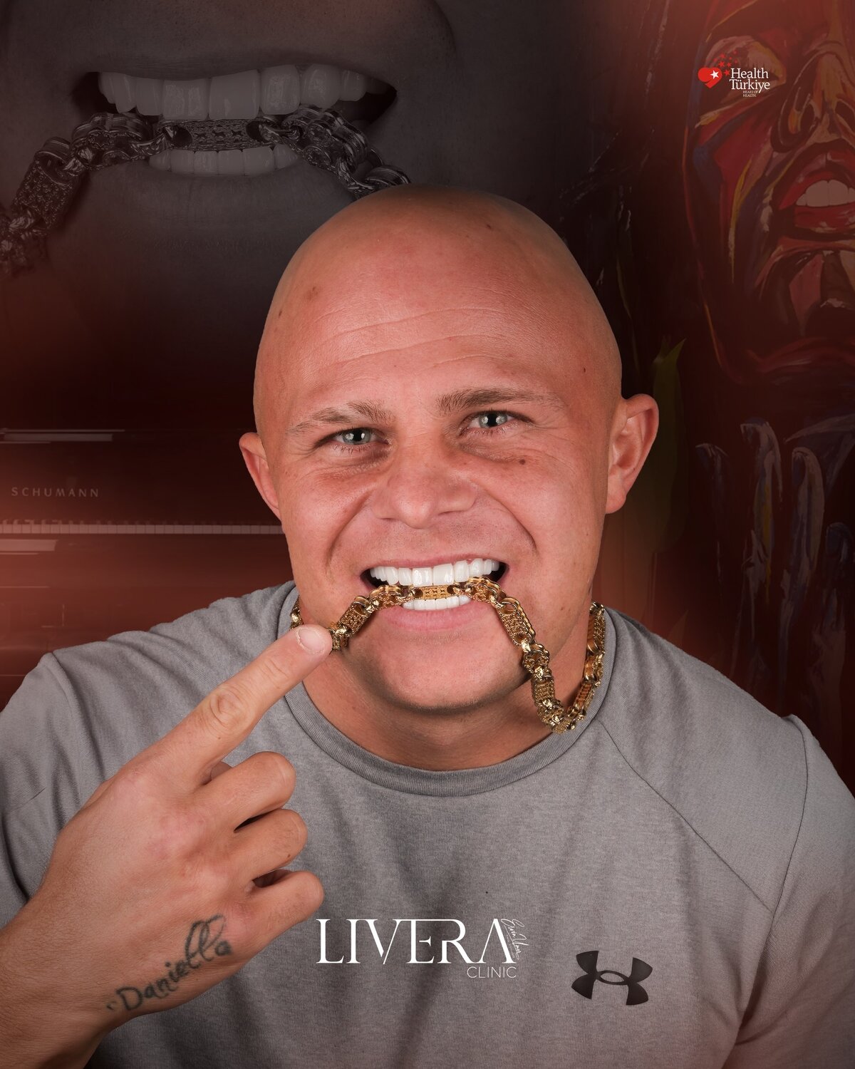 E-Max Kaplama